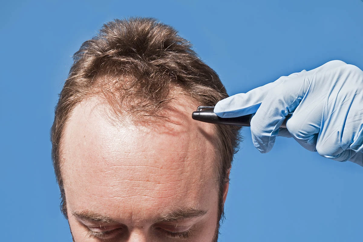 Scalp Care Routine Post Hair Transplant