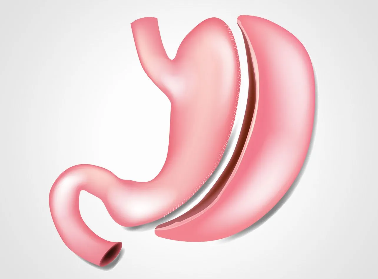 Sleeve stomach