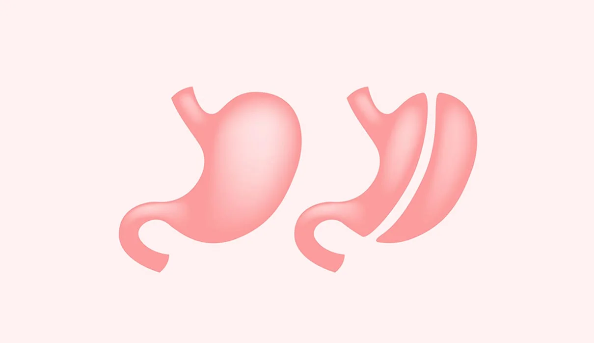Sleeve stomach