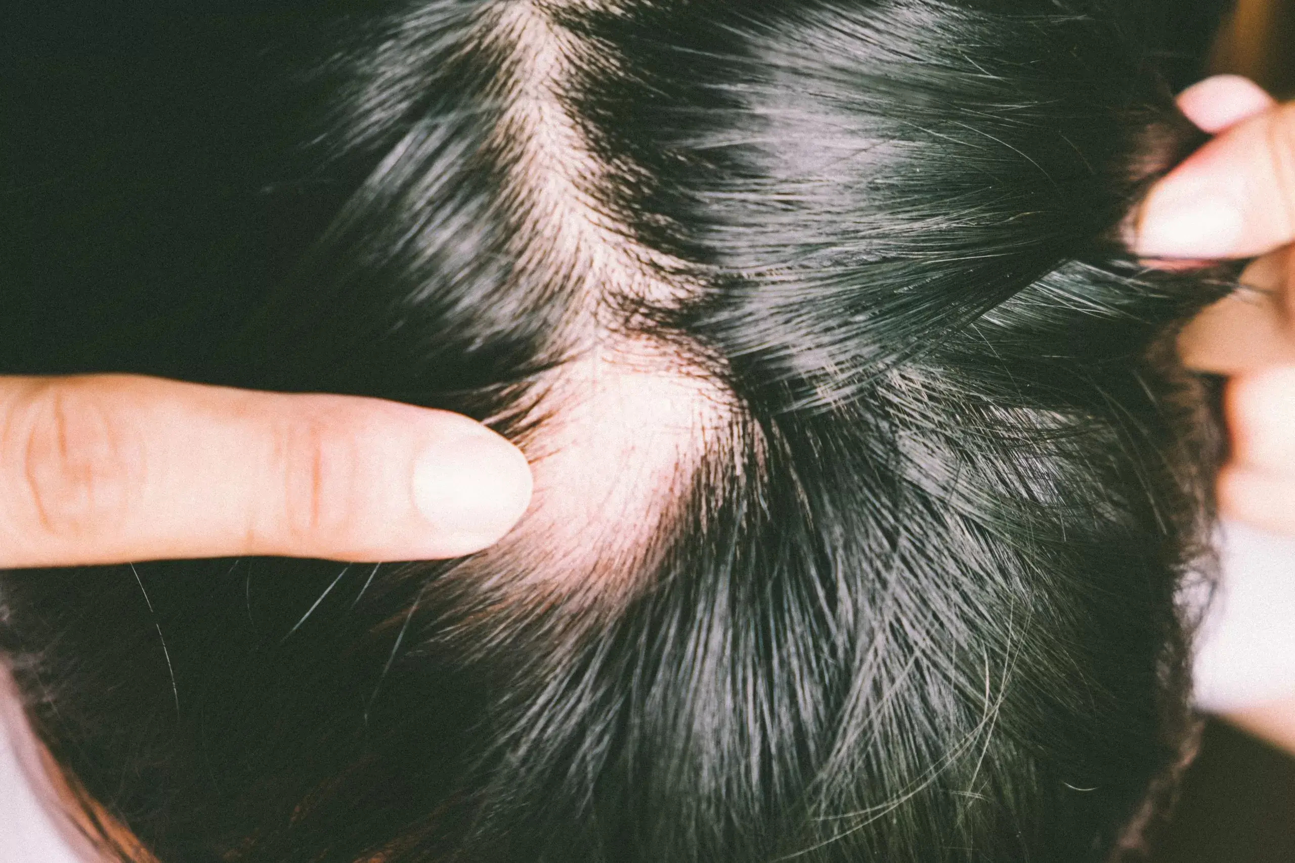 Spotted Hair Loss