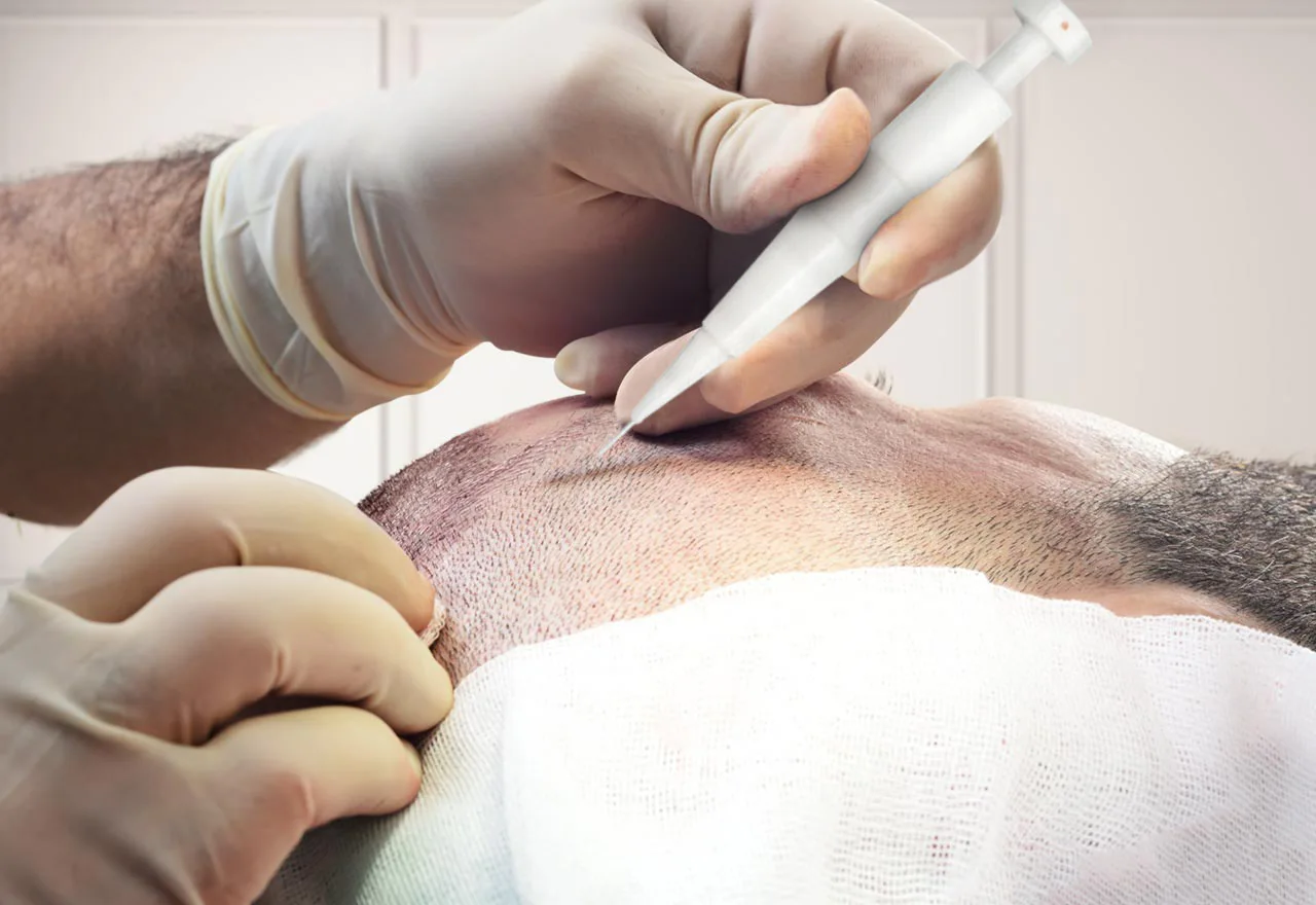 Turkey hair transplant 