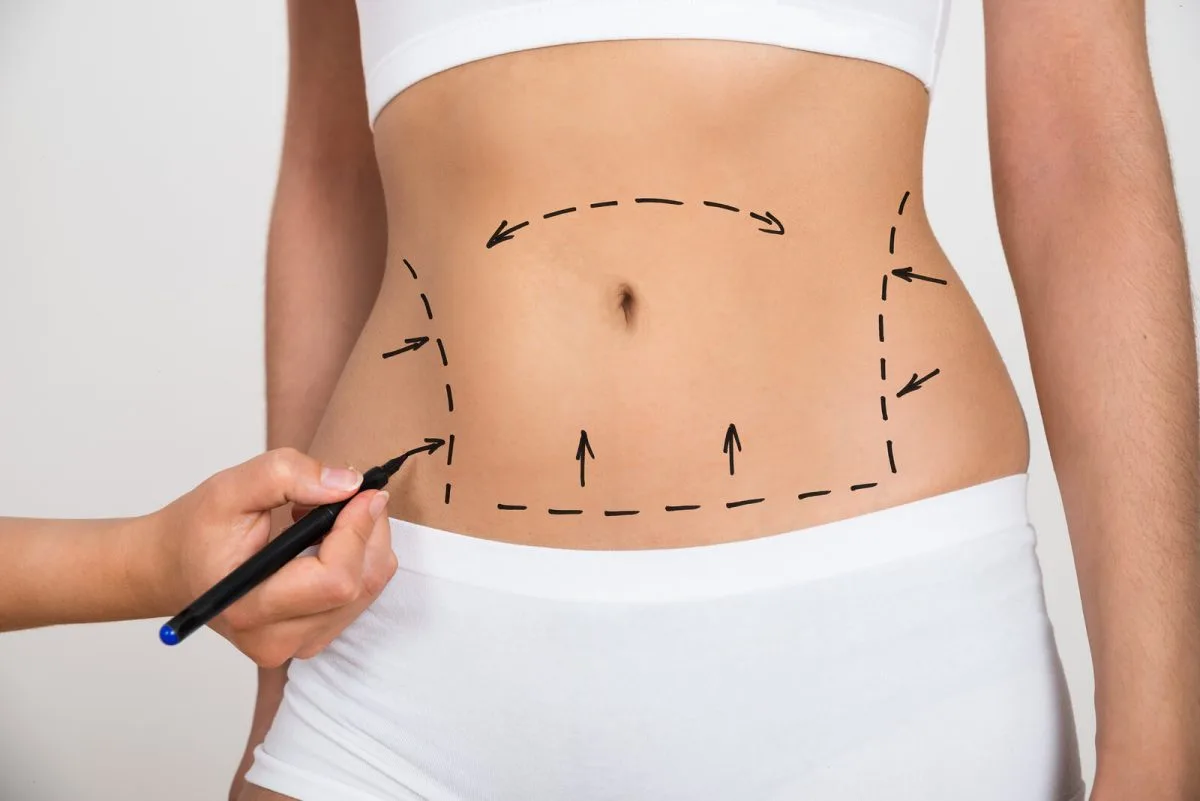 Mini Tummy Tuck
