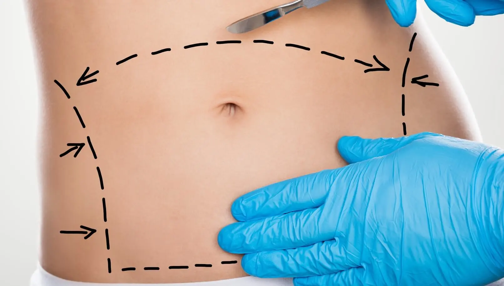 Abdominal Surgery