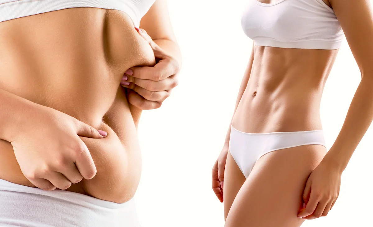 What is Gastric Balloon Surgery